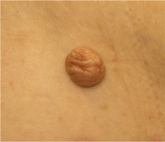 軟性線維腫（soft fibroma）