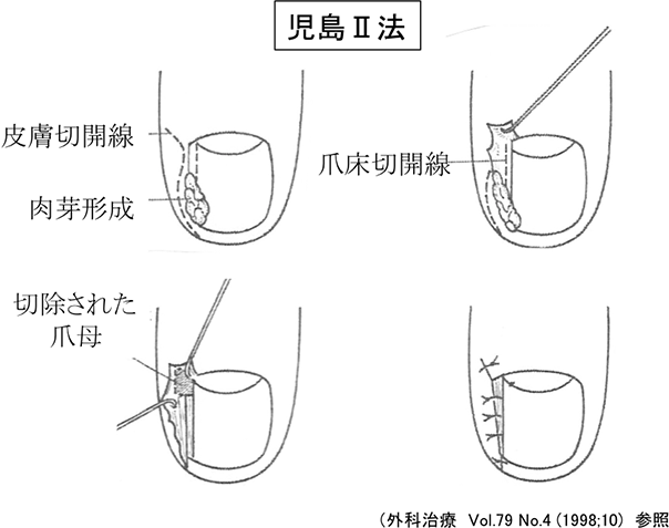 児島Ⅱ法