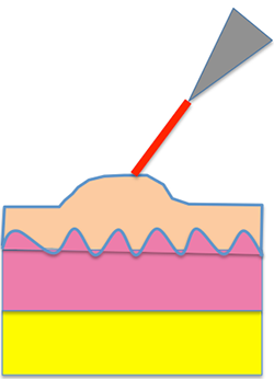 レーザー照射し病変を削切