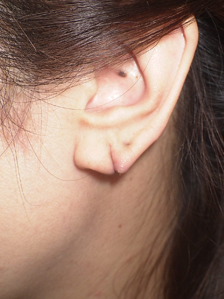 耳垂裂（切れ耳）
