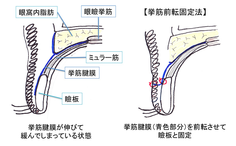 挙筋前転固定術（挙筋前転法）