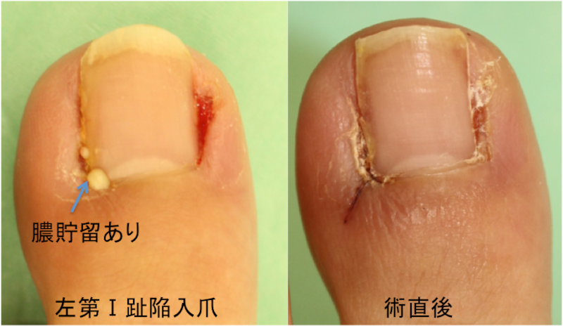 陥入爪 Ingrown Nail について Yuki皮フ科形成外科 一宮市時之島の皮膚科 形成外科