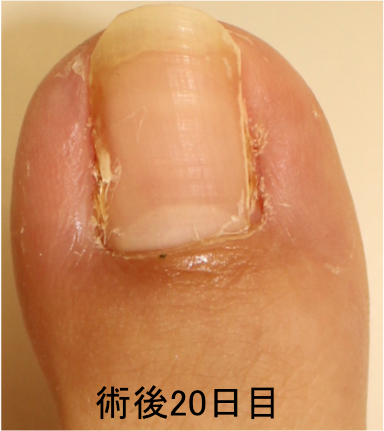 陥入爪 Ingrown Nail について Yuki皮フ科形成外科 一宮市時之島の皮膚科 形成外科