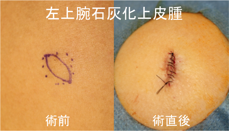 石灰化上皮腫 経過