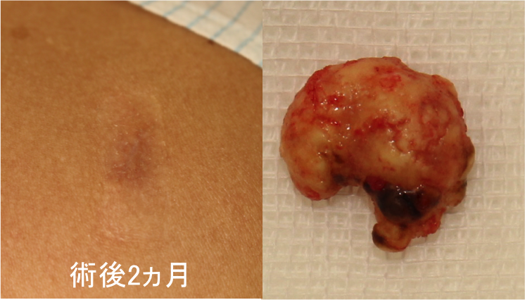 石灰化上皮腫 経過2