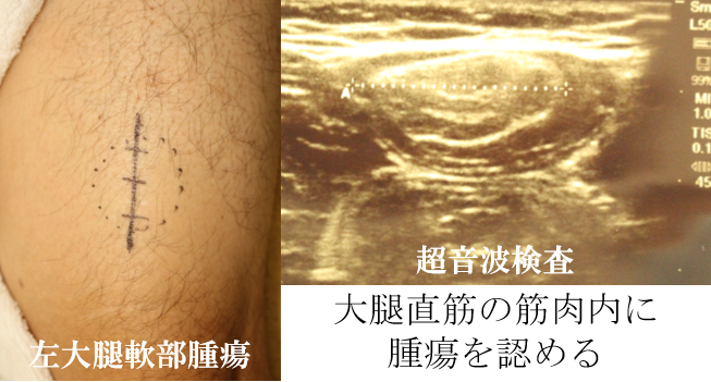 腫瘍摘出術の長所と短所