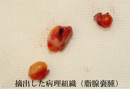 摘出した病理組織