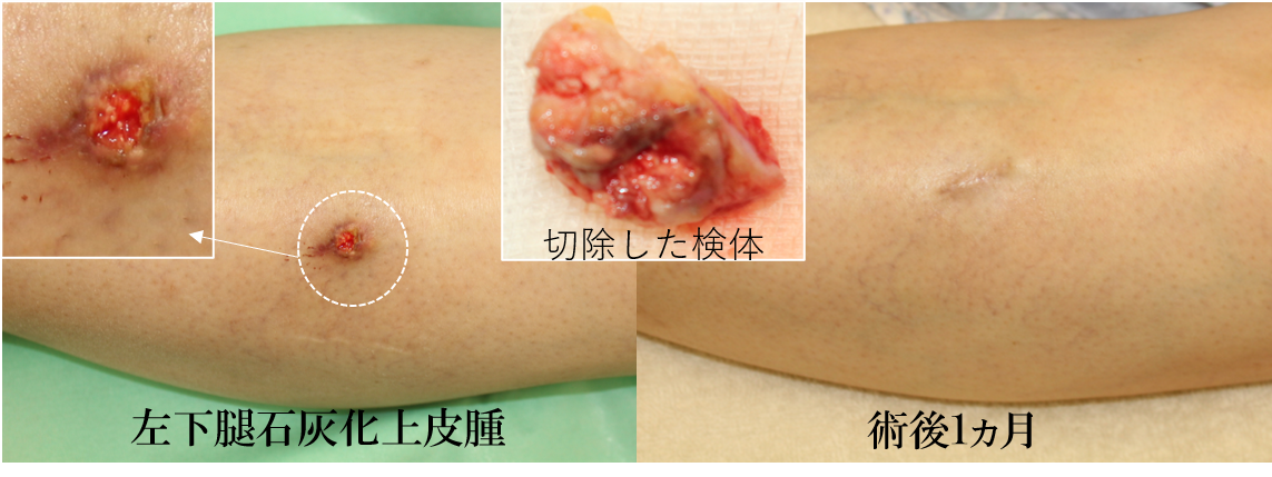 石灰化上皮腫　経過3