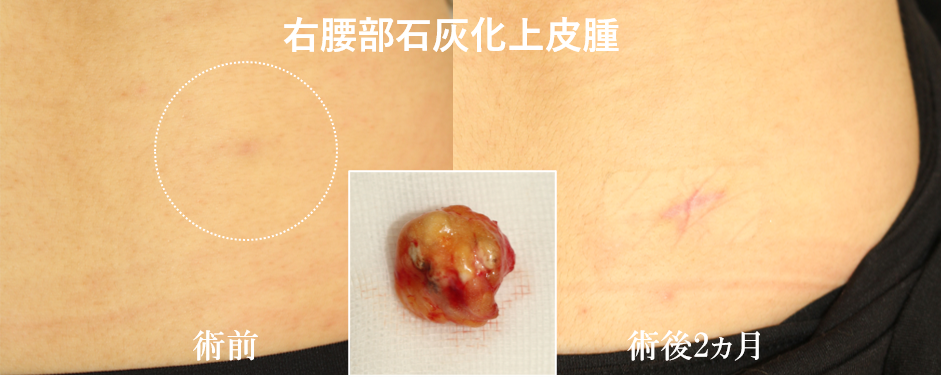 石灰化上皮腫 経過4