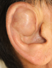 耳介偽嚢腫