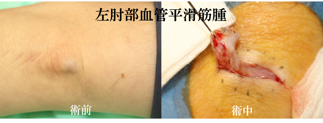 血管平滑筋腫