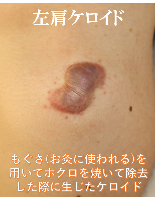 左肩ケロイド