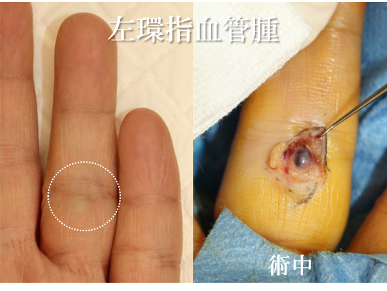 左環指血管腫経過
