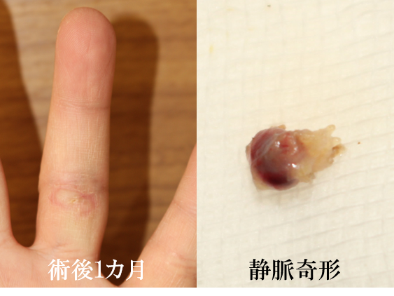 左環指血管腫経過