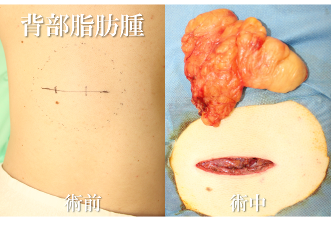 右腰部脂肪腫　治療経過