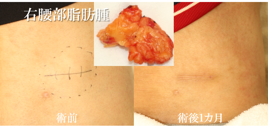 右腰部脂肪腫　治療経過